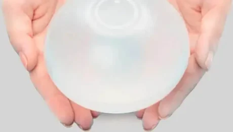 como es un balon gastrico