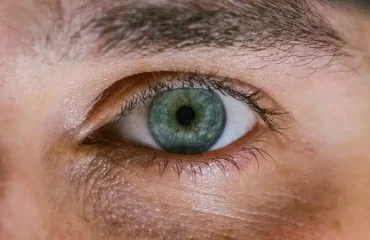 blefaroplastia-sin-cirugia Blefaroplastia sin cirugía