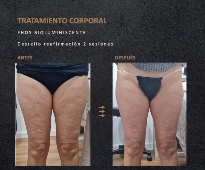FHOS. Reafirmación corporal - Fotos antes y después FHOS. Reafirmación corporal